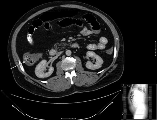 Thickening observed on CT scan at the time of initial presentation. Note the arrow pointing to cecum on axial section.