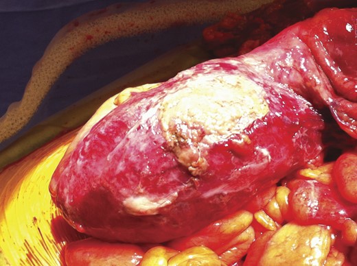 Cecal perforation identified at the time of operation. Gross inflammation observed from the ileocecal junction to the mid-transverse colon.