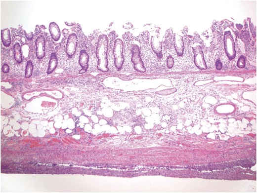 A representative section showing inflammation involving all layers of the colonic wall. The submucosal layer is slightly edematous, while the muscular layer is attenuated. The prominent acute and chronic inflammation involving the pericolonic soft tissue and peritonealized surface is consistent with the clinical impression of perforation.