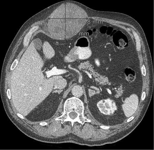 CT abdomen: lesion in the abdominal wall, possibly originating from the rectus abdominis muscle.