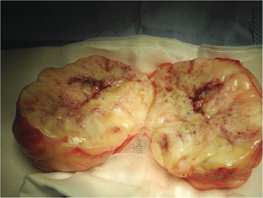 Tumour ex vivo, note the lobular structure with fibrous septa (incised).