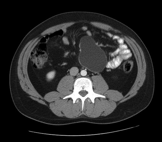 Computed tomography view of the mesenteric cyst.
