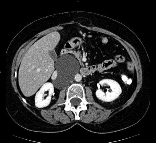 Computed tomography view of the mesenteric cyst partially dislocating the caval vein.