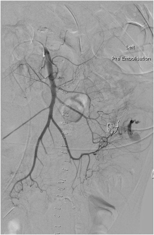 Arteriogram showing active bleeding from branch of the superior mesenteric artery into the jejunum (arrowed), which was subsequently embolized.