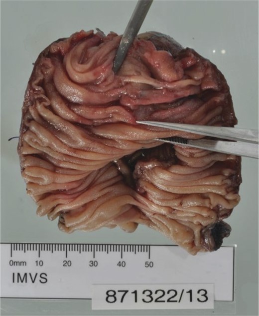 Resected segment of jejunum showing numerous ulcers ranging up to 30 mm in diameter with no discreet mass lesion. Histological examination showed these ulcers penetrated to differing levels including the full thickness of the bowel wall.