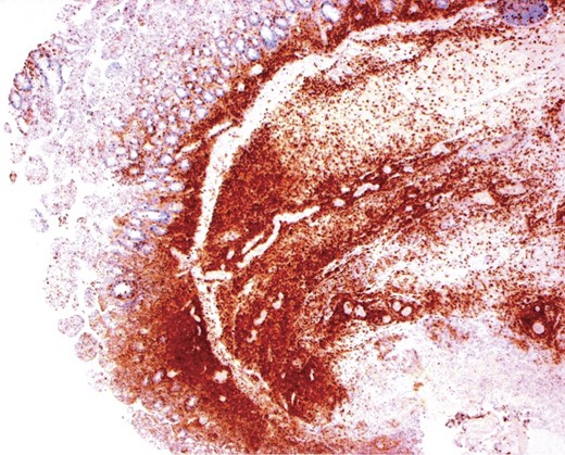 CD8 immunohistochemical stain, small bowel: brown staining indicating the CD8+ T lymphocytes in the mucosa and remaining bowel wall. The large amount of T-lymphocytes is surprising given the more subtle H&E appearance.