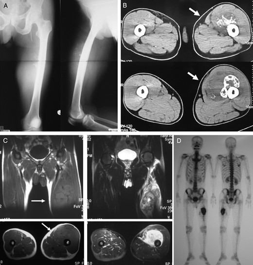 A 54-year-old male with primary soft tissue sarcoma. Plain radiograph (A) and CT (B) showing lytic destructive lesion in left femoral diaphyseal bone. T1- and T2-weighted magnetic resonance imaging (C) showing a soft tissue mass (20 × 20 × 12 cm) around femoral bone. Bone scintigraphy (D) showing increased uptake in femoral diaphyseal bone.