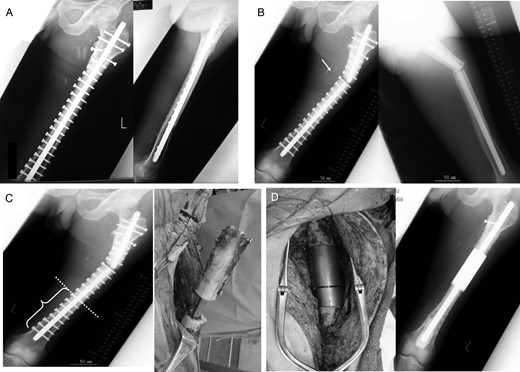 Radiographs showing extracorporeal irradiation after wide resection and stabilization with intramedullary nail (A). At 74 months after operation, radiograph showing fracture of graft bone with broken implant (B and C) and revision with intercalary endoprosthesis (D).