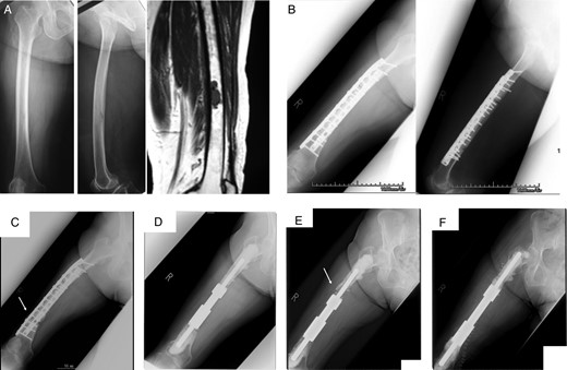 A 68-year-old female with metastatic synovial sarcoma in right femoral diaphyseal bone. Plain radiograph and MRI (A) showing metastatic bone tumor. Radiograph (B) showing wide resection included femoral diaphyseal bone and reconstruction with IORBG and plate. At 32 months after surgery, radiograph (C) showing graft bone fracture (arrow) and reconstruction with intercalary endoprosthesis (D). Aseptic loosening occurred 29 months after surgery (E), and revision surgery was performed (F).