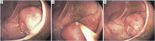 Ileocecal plasmacytoma. Gross appearance of polyp during the diagnostic colonoscopy for our case. The polyp measured nearly 4 cm and had an obvious ulceration on its surface as shown. It had a thin, long stalk and so was removed by hot snare.