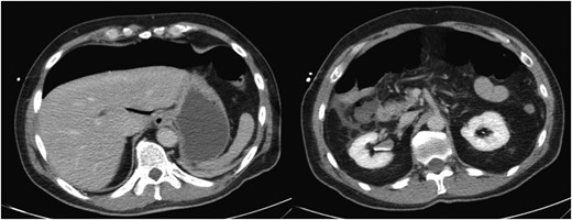 Colonoscopic perforation on CT. CT scan of the abdomen revealing significant intra-abdominal free air (left). On a lower portion of the scan, there are inflammatory changes evident in the right lower quadrant in the region of the ileum and cecum (right). These structures are difficult to discern in the presence of the inflammatory changes.