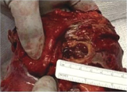 Gross pathology of colonoscopic injury to ileocecal junction. Gross pathology of the iatrogenic colonoscopic injury to the ileocecal junction sustained during the snare polypectomy. The perforation measured ∼2.5 cm across the ileocecal valve.