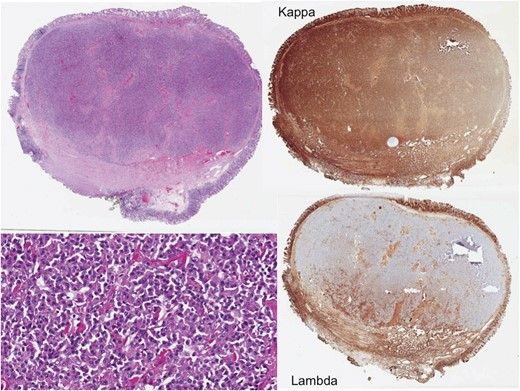 Histology of the ileocecal plasmacytoma. Pathology revealed that the polyp was an extramedullary plasmacytoma. The top left shows H&E staining and the bottom left shows increased magnification, illustrating classic cartwheel nuclei. The top right and bottom right show special staining for either the kappa or lambda light chain, respectively. Here the polyp specifically stains for the kappa light chain, indicating that it comprised a monoclonal population of plasma cells.