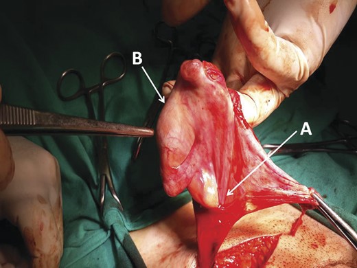 Sliding indirect inguinal hernia sac. (A) The hernia sac. (B) Testis constitutes a component of the hernia sac.