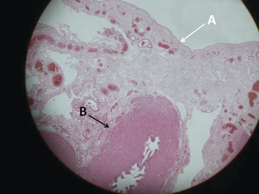 Microscopic section of the hernia sac. (A) Inside of the hernia sac. (B) The ductus deference makes up a part of the sac wall (H&E ×20).