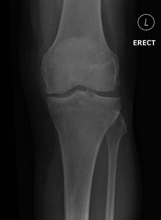 AP view: left patella at initial presentation.