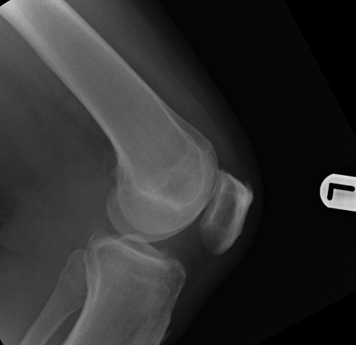 Lateral view: left patella at initial presentation.