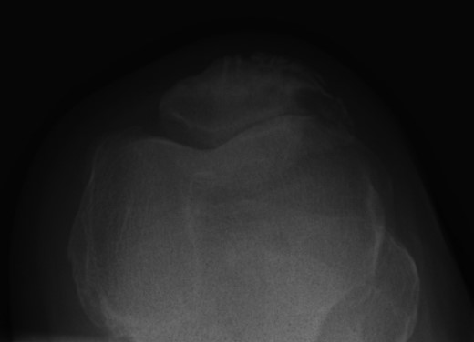 Skyline view: left patella at initial presentation.