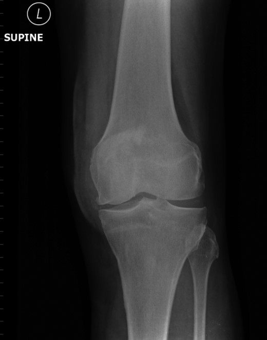 AP view left patella at subsequent presentation.