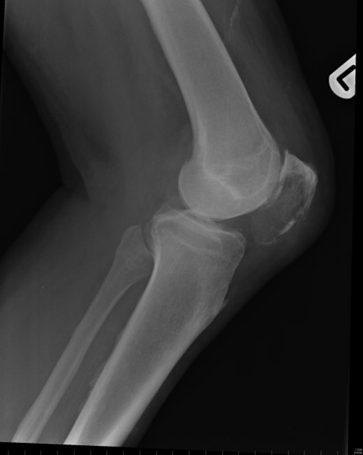 Lateral view: left patella at subsequent presentation.