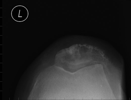 Skyline view: left patella at subsequent presentation.