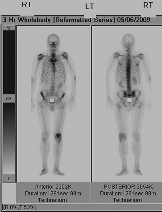 Whole-body bone scan demonstrating isolated increased tracer uptake around the left patella.
