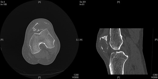 Axial and sagittal CT Images of left patella.