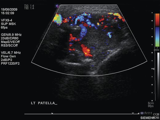Ultrasound scan of the left patella, showing extensive neovascularization and increased flow within the lesion.