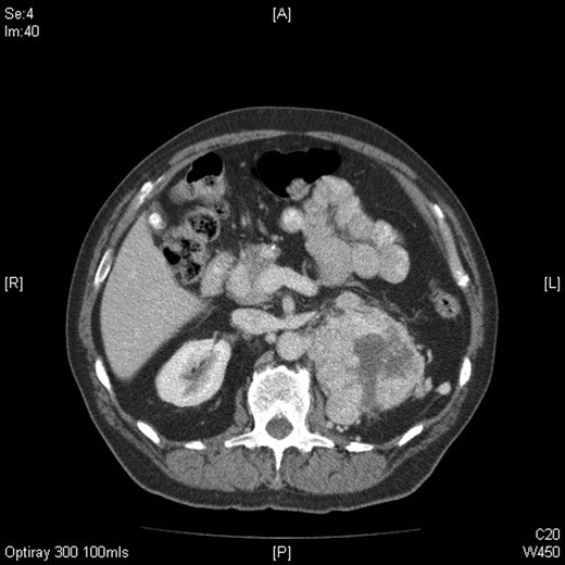 Axial CT image of the abdomen confirming the presence of a large mass arising from the superior pole of the left kidney measuring 13 (craniocaudal) × 8.5 (side to side) × 9 (AP) cm with central areas of necrosis.