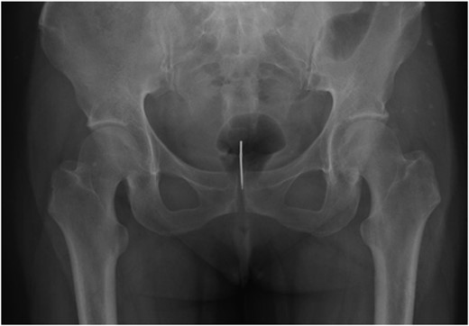 Pelvic X-ray shows a 3-cm radiopaque foreign body.