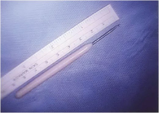 Crochet needle removed from the bladder.