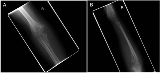 (A) Anterior–posterior radiograph of the elbow and (B) lateral radiograph of the elbow. Admission right elbow radiographs.