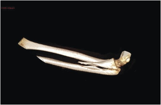 Computer tomography 3D reconstruction of the fracture pattern. Right elbow computer tomography admission images.