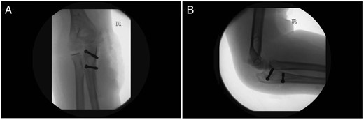 (A) Anterior–posterior and (B) lateral fluoroscopy images with two cannulated screws in situ. Fluoroscopy images taken in theatre post-fracture fixation.