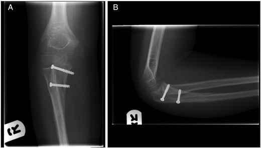 (A) Anterior–posterior and (B) lateral radiographs of the right elbow. Images taken at 5 weeks post-reduction.