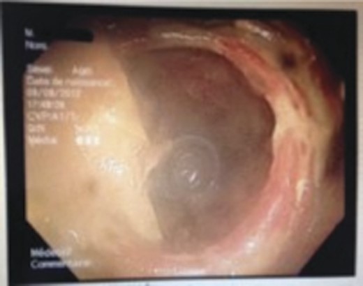 Aspect of the foreign body seen by endoscopy.