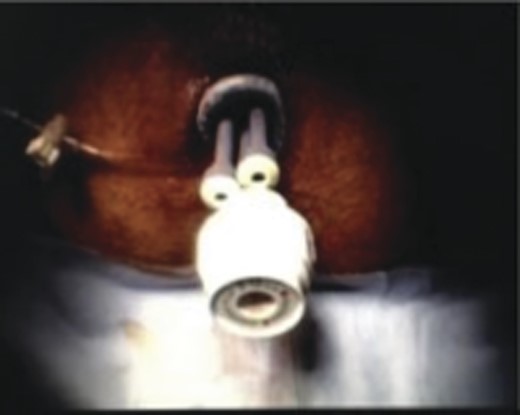 SILS port in the anus.