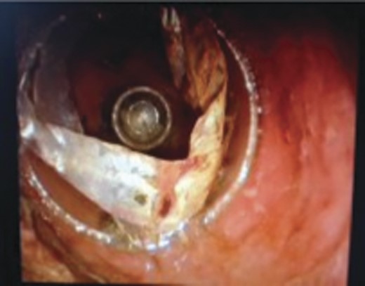 Foreign body seen by laparoscope.