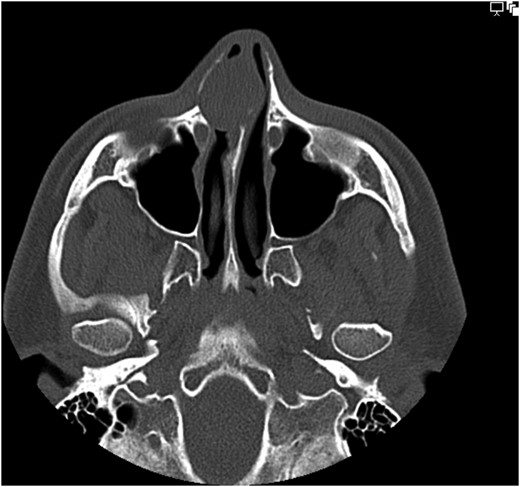Axial image of non-contrast CT sinus scan.