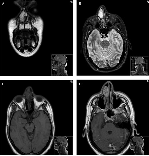 (A) Coronal image of T2-weighted turbo spin echo (TSE) MRI of the sinonasal region. (B) Axial image of STIR (short tau inversion recovery) MR sequence through the sinonasal region. (C) Axial image of T1-weighted MR sequence through the sinonasal regions. (D) Post-contrast T1-weighted axial image through the sinonasal region.