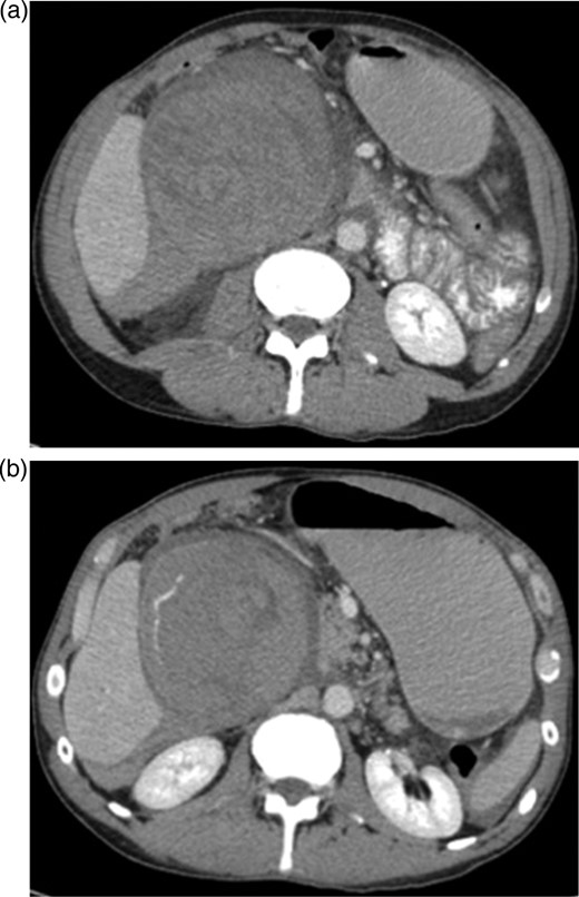 (a and b) CT scan upper abdomen showing a large haematoma in the gallbladder fossa, which distends the gallbladder wall causing mass effect.