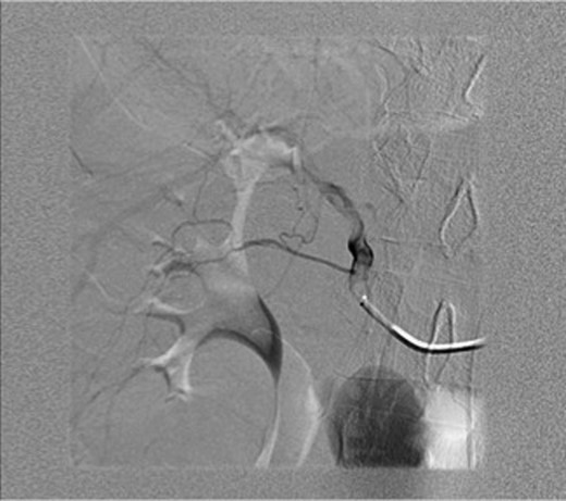 Arteriogram of abdominal aorta and splanchnic vessels showing localized bleeding in a branch of the cystic artery and no pseudoaneurysm.