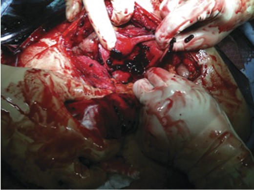 Intraoperative picture of gall bladder.