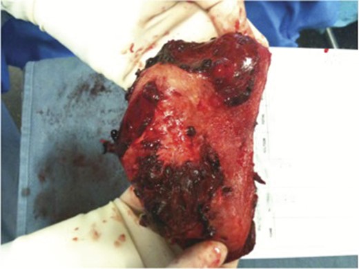 Intraoperative picture of gall bladder.
