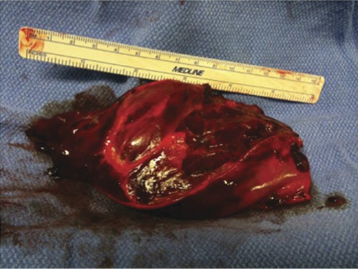 Intraoperative picture of gall bladder.