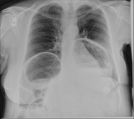 Erect chest radiograph, showing a large hiatus hernia and large loop of bowel elevating the right hemidiaphragm.