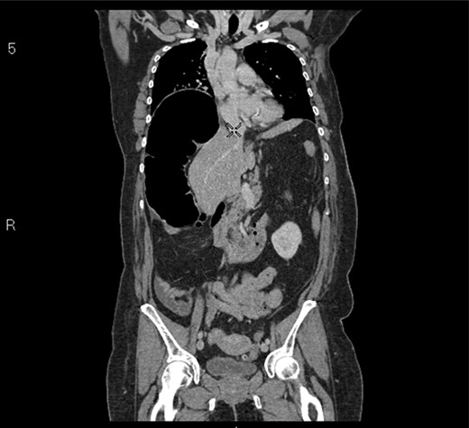 CT coronal section demonstrating caecum medially displacing the liver and causing an upward pressure on the right hemidiaphragm.