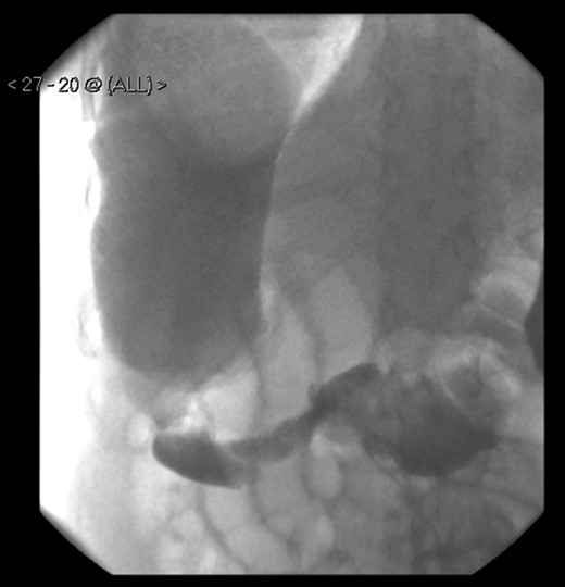 A large bowel contrast study showing the flow of contrast from the collapsed transverse colon into the dilated, upwardly displaced caecum.