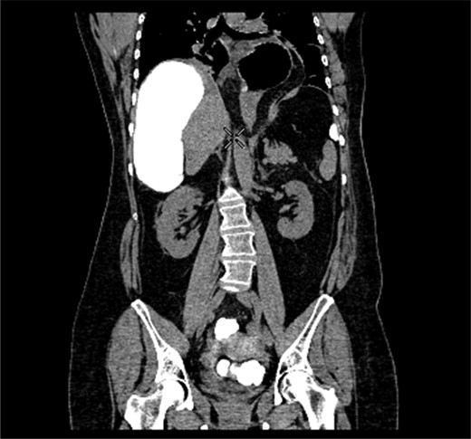 Coronal section of contrast-enhanced CT demonstrating contrast filling upwardly displaced caecum.