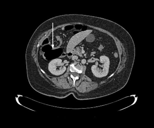 Axial section of contrast-enhanced CT demonstrating ‘whirl sign’ at the point of volvulus.